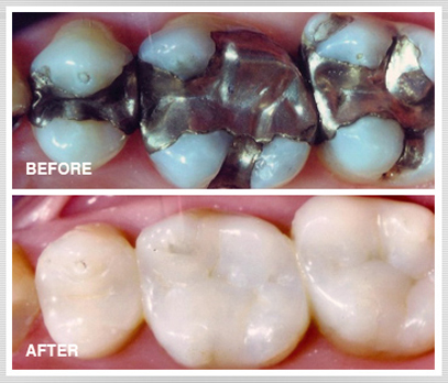 composite filling