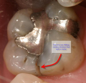 cracked tooth symdrome