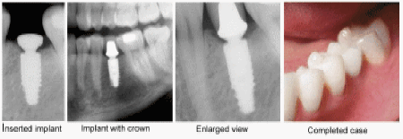 implant pix