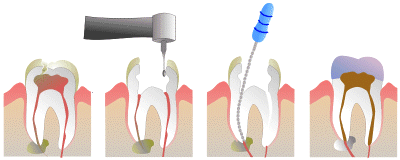 root canal treatment