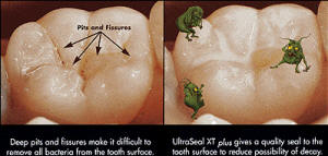 dental sealants-01